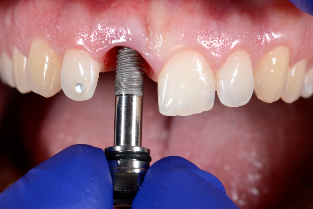 Dental Implants In Kharadi