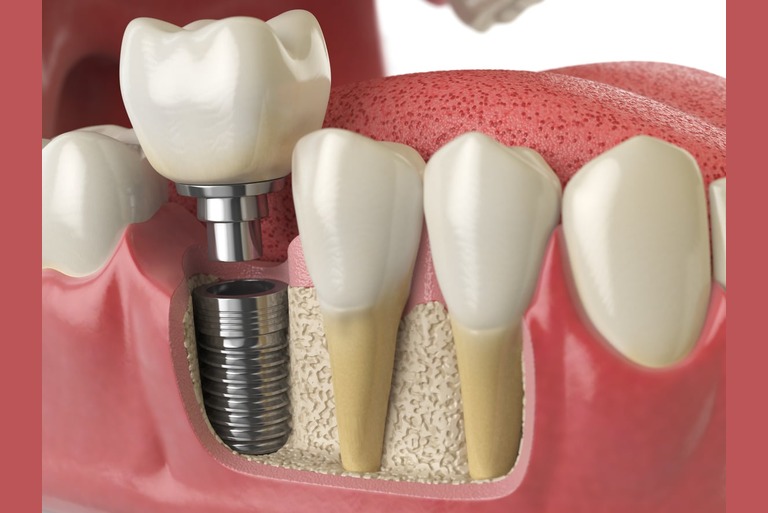 Pain-Free Dental Implants in Pune: How Modern Technology Ensures a Comfortable Experience