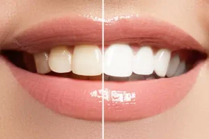 Teeth Whitening in kharadi 
