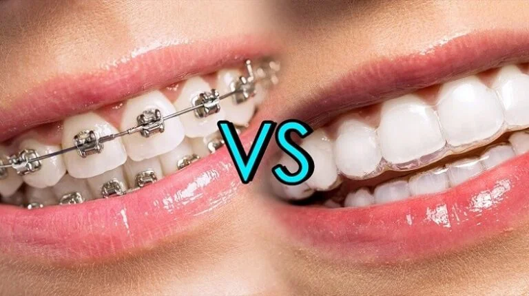 Braces Vs Aligners