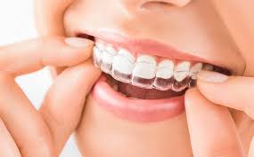 Aligner