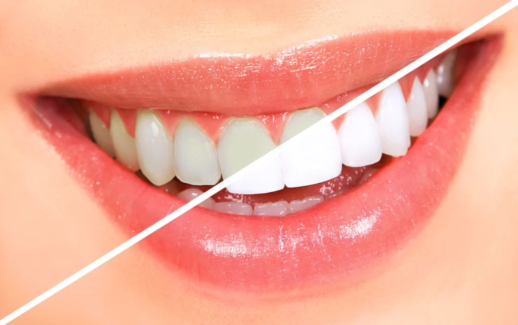 Teeth Whitening in kharadi