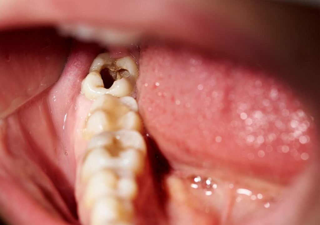 Fdead Tooth Tooth Extractions in pune | Free Dental Checkup | Wisdom Tooth