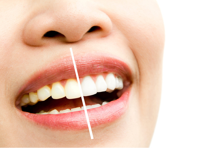 Teeth Whitening kharadi