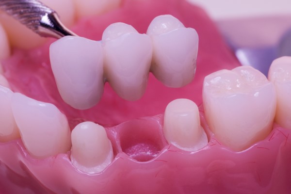 Dental Restoration in Pune