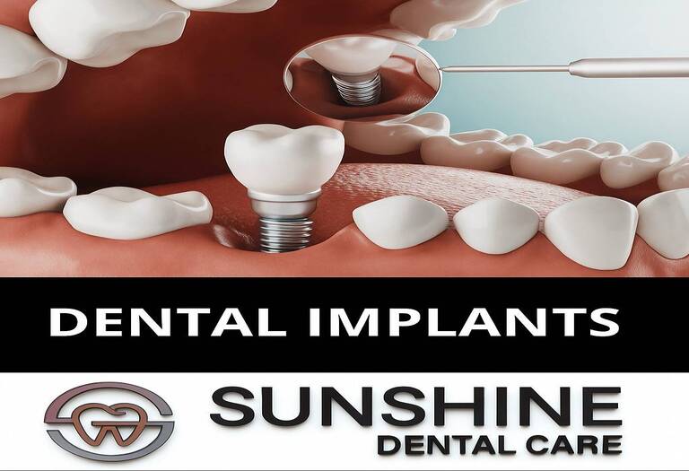 Dental Implants Near Me