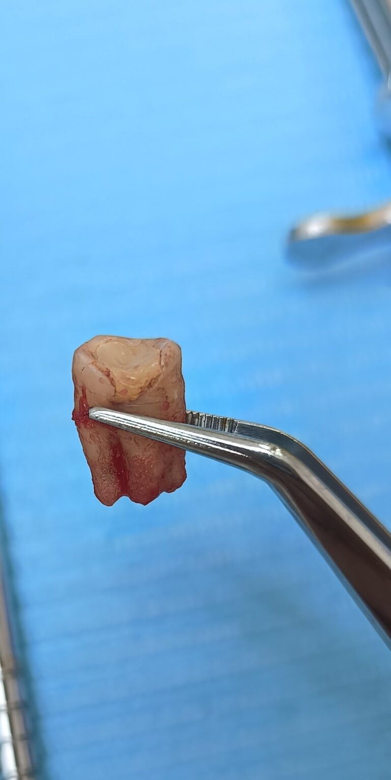 Tooth Extraction in Pune