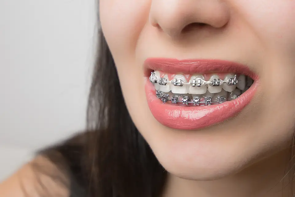 Braces Cost in Pune | Sunshine Dental Care Kharadi Pune