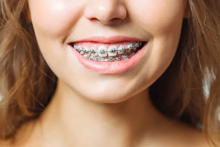 Braces Cost in Pune