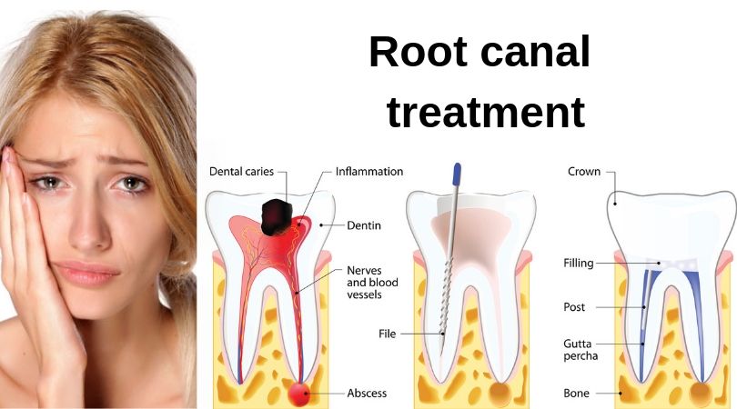 root canal treatment