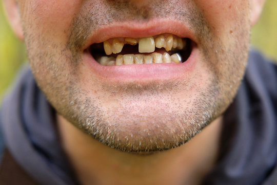 5 Daily Habits That Damage Teeth