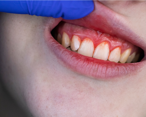 Gum Surgery Kharadi Pune