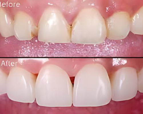 Aesthetic Restorations