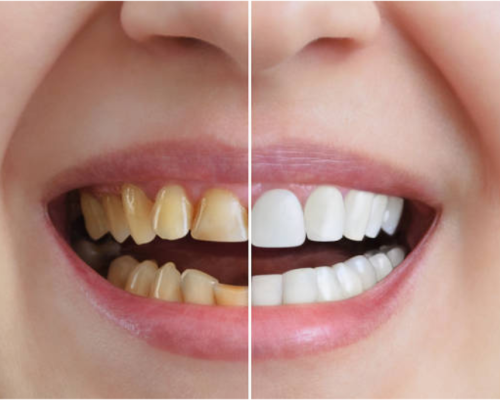 Cosmetic Dentistry in Kharadi