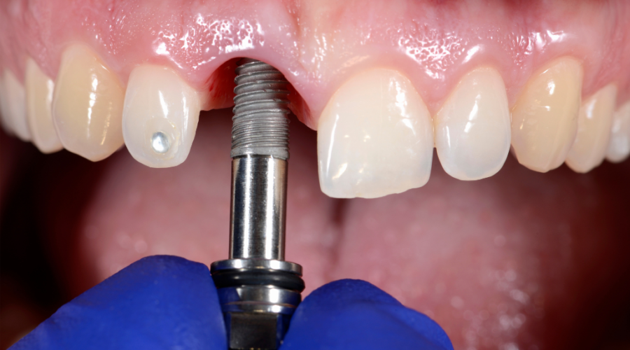 Dental Implants